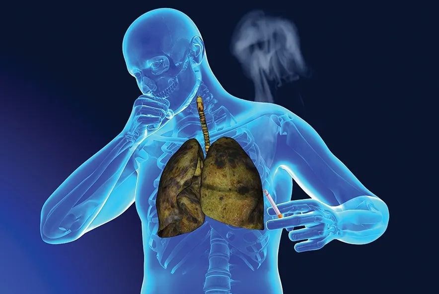 Prof. Dr. Tevfik Özlü: “Akciğer kanserlerinin yüzde 90’ının sebebi sigara”